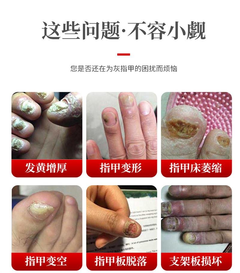 美國 南京同仁堂 灰指甲專用液體 甲溝炎藥水修腳剪刀冰醋酸抑菌液 30ml+小搓板+棉花棒+護理貼+增效膏