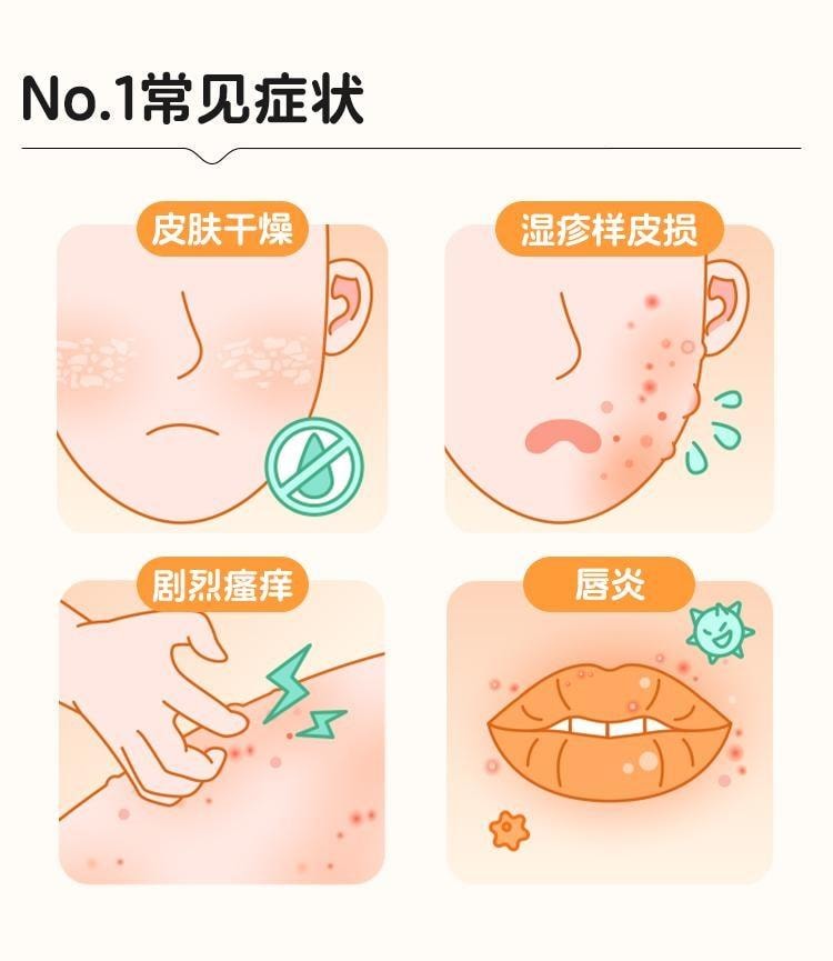 【中国直邮】  华邦 卤米松乳膏 用于非感染性炎症性皮肤病 脂溢性皮炎、寻常型银屑病 10g*1支/盒