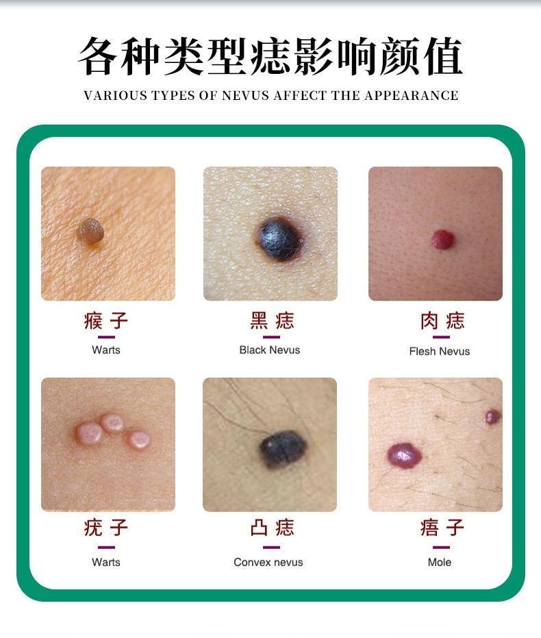 香港大药房 点痣膏 无痕点斑去痣水志脸部专用除去黑痣祛膏 5g/盒