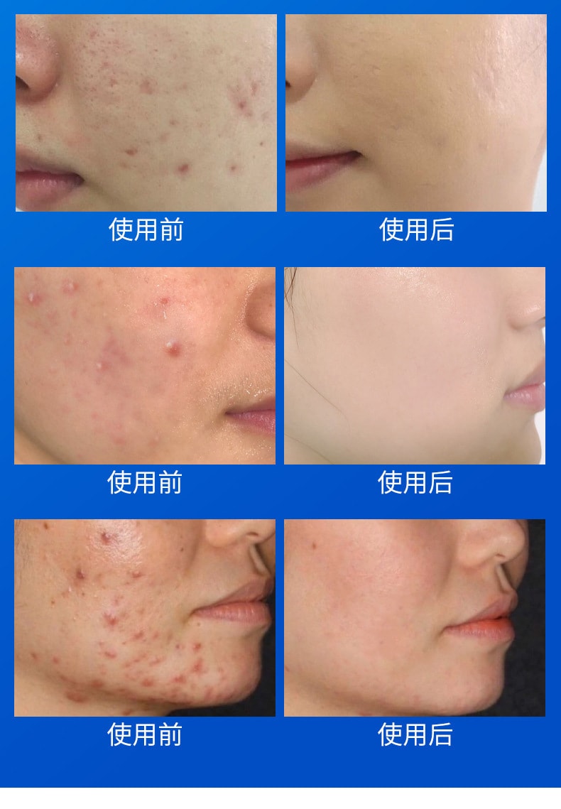 【中国直邮】仁和 水杨酸祛痘调理乳淡化痘肌痘印温和去痘痘30g (买二送一)