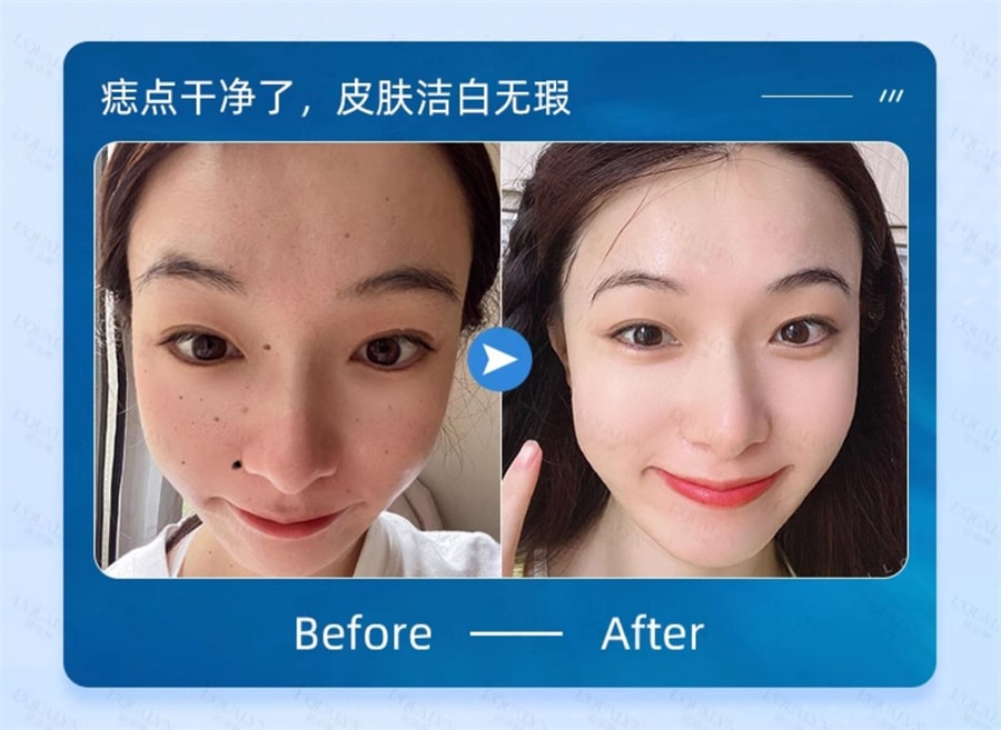 【中国直邮】欧泉琳 点痣膏无痕脸部去痣淡斑神器点痣笔非药水点斑美容专用 5g/瓶+5ml/瓶