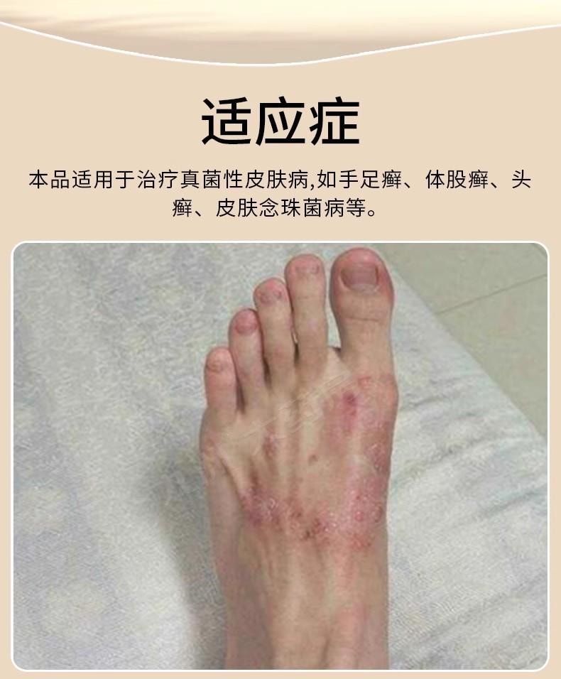 【中國直郵】 華邦 萘替芬酮康唑乳膏 治療真菌性皮膚病 手足癬 體股癬 頭癬 皮膚念珠菌病等 10g/盒