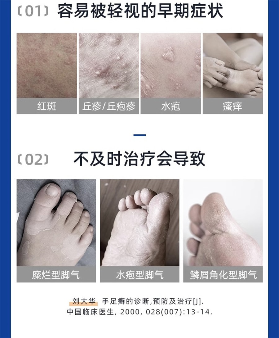 【中国直邮】限时特价 三九 999皮炎平 曲安奈德益康唑乳膏20g皮炎湿疹手足癣体癣甲沟炎