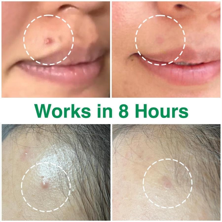 韓國 ACROPASS 微針粉刺修護貼 – 4片裝 淨膚護理