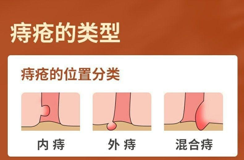 【中国直邮】 马应龙 麝香痔疮栓 痔疮消肿止痛止血 神器消肉球痔疮药 18粒/盒