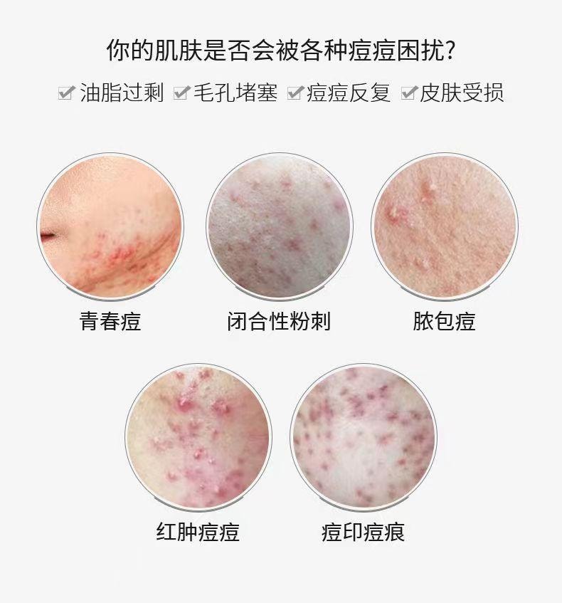 军献 精华去痘膏25g 草本祛痘祛粉刺  淡化痘印 水杨酸包裹细致平滑肌肤