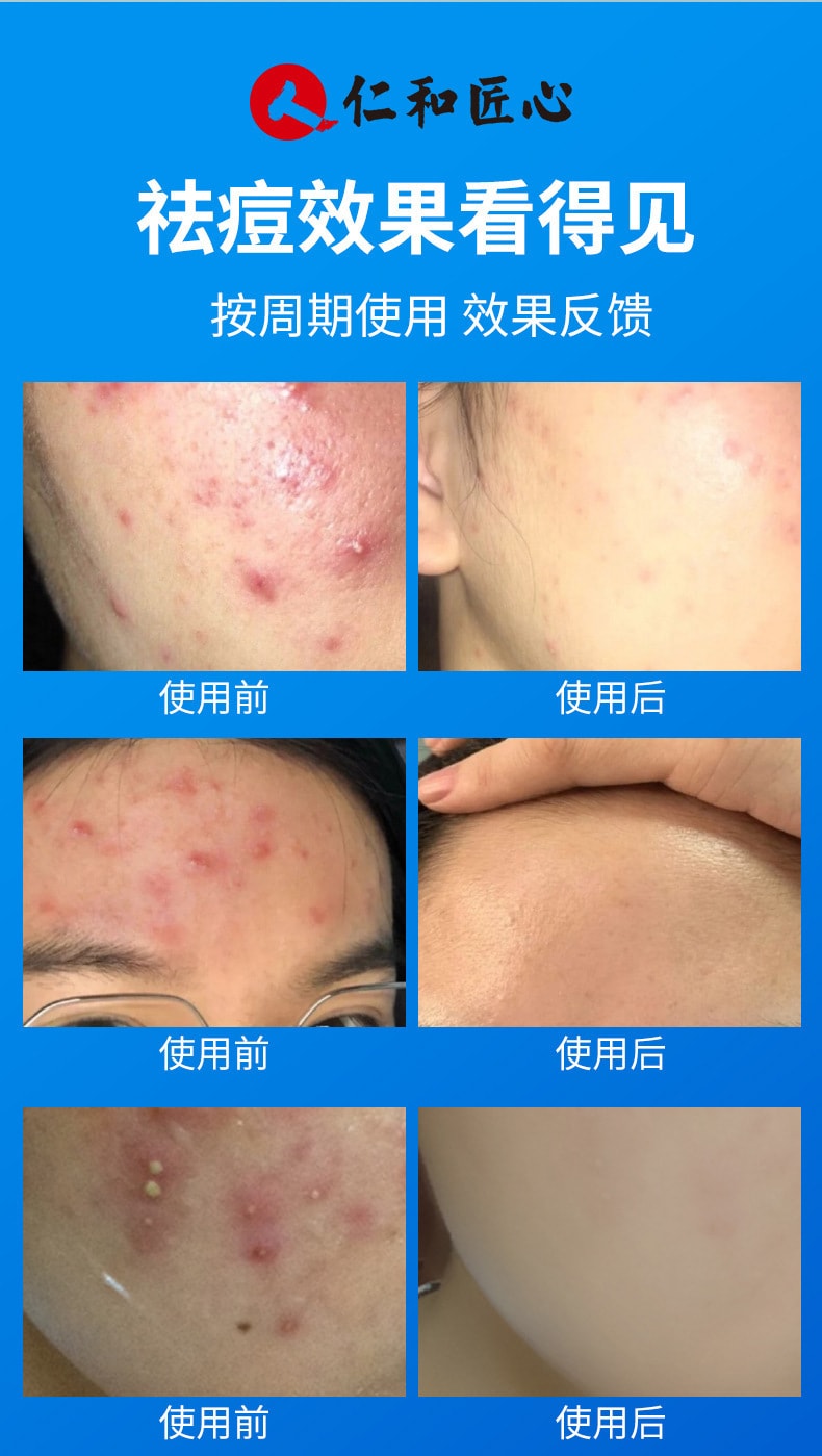 【中国直邮】仁和 水杨酸祛痘调理乳淡化痘肌痘印温和去痘痘30g (买二送一)