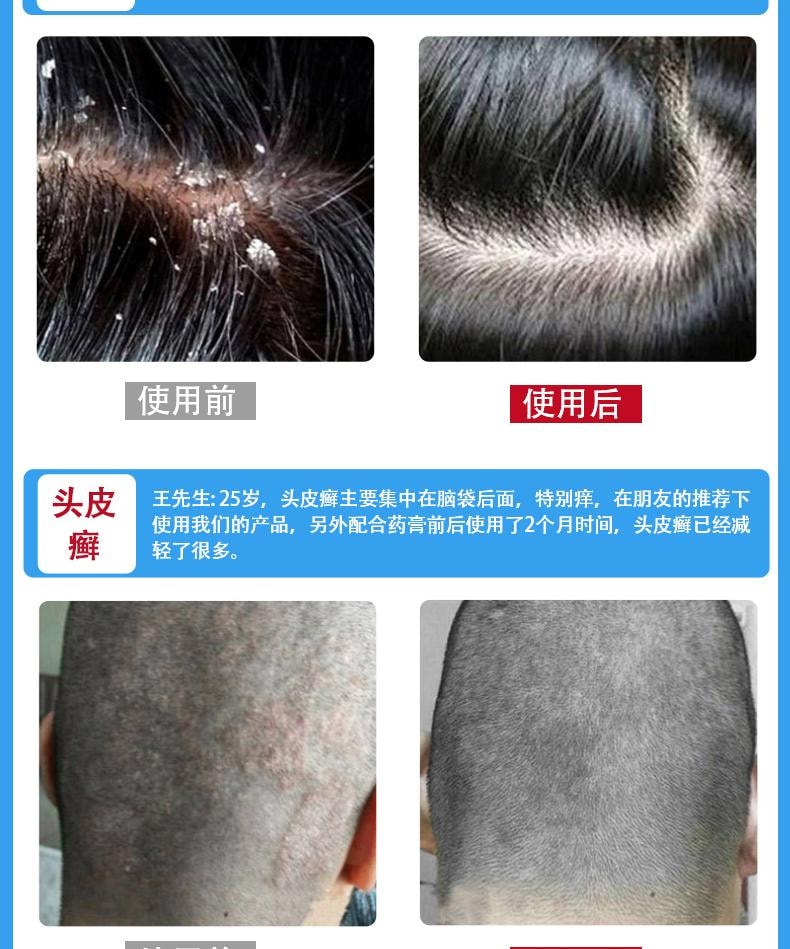 【中国直邮】 祥医堂 苦参碱洗发水 含碱pca锌洗发水 洗头去屑止痒苦渗减正品 110ml/盒