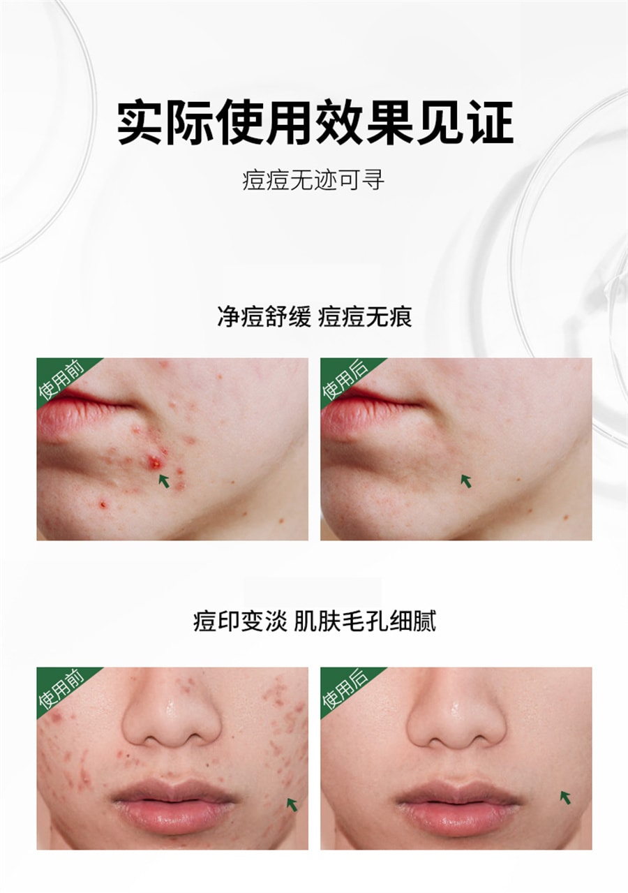 【中国直邮】仁和匠心 药业正品青春痘祛痘膏淡化痘印凝胶去痘闭口芦荟胶男女非 22g