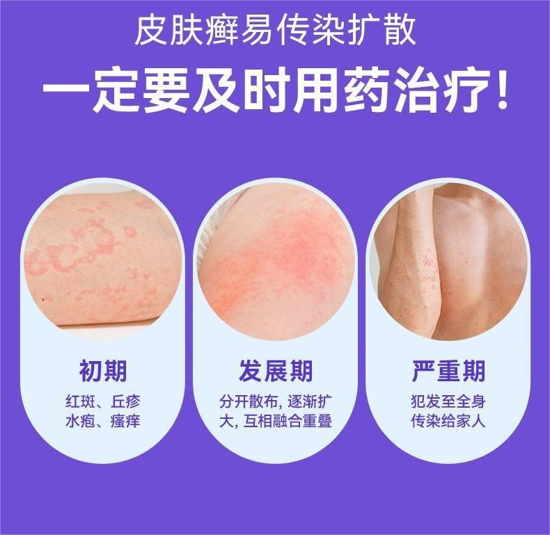 Bifonazole cream 15g per vial