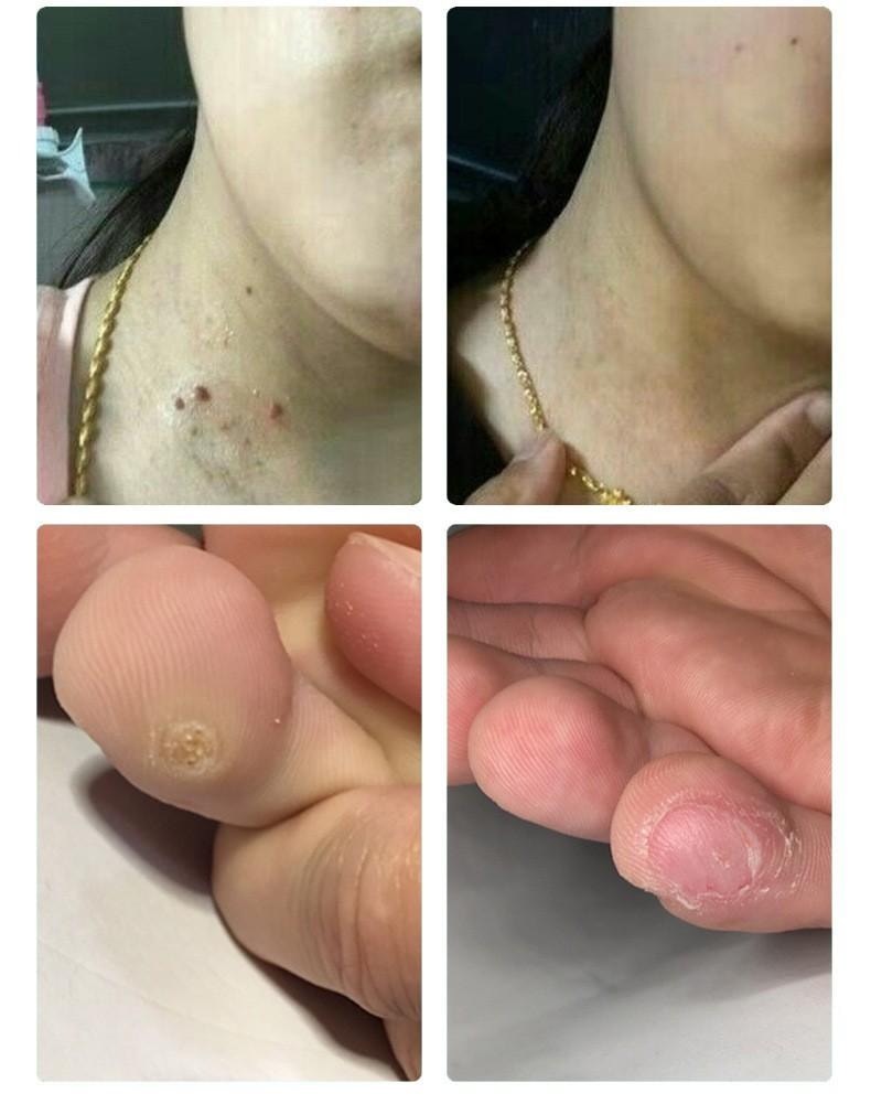  祥醫堂 絲狀扁平疣克尤刺瘊脖長小肉粒外用藥膏 5%咪喹莫特乳膏20g