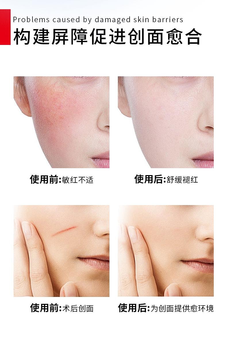 【中国直邮】 舒奈美 医用人源化胶原蛋白敷料术后面部修护激光晒后补水冷敷面膜  4片装/盒