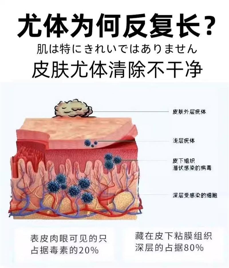 祥医堂 鬼臼毒素酊10ml/盒 去鸡眼尖锐丝状扁平克疣抑菌外用