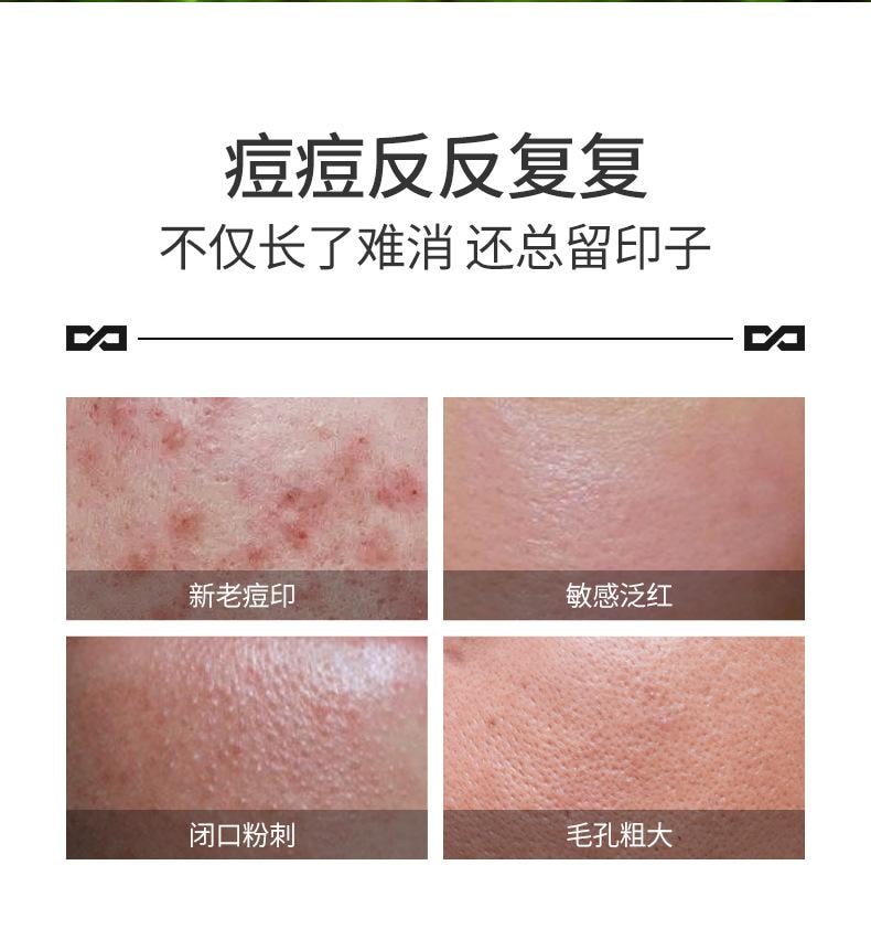 【中国直邮】 左颜右色 补水面霜控油 不粘腻祛痘 凝胶男女通用祛痘膏10g