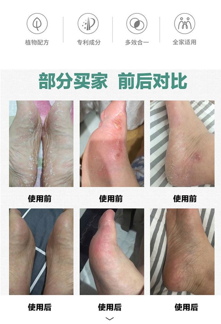 【中国直邮】严和 皮肤瘙痒抑菌乳膏 效果显著 快速缓解 止痒清肌 18g/盒