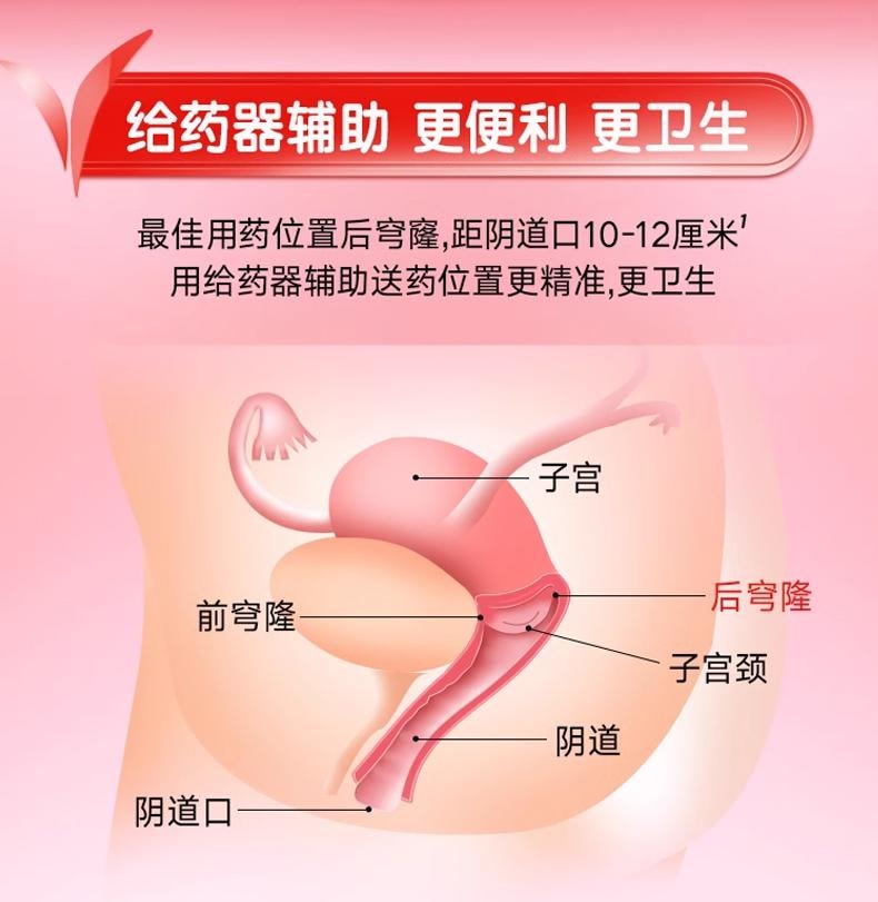 凯妮汀 克霉唑阴道片 1片 阴道炎 妇科炎症专用药 一盒一片一疗程 单盒装