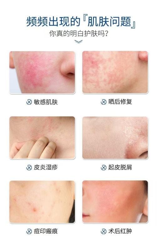 【中国直邮】  复因 透明质酸钠修复凝胶修复液轻重度痤疮医用级晒后激光术冷敷创面部修复 30g【院线刮码】