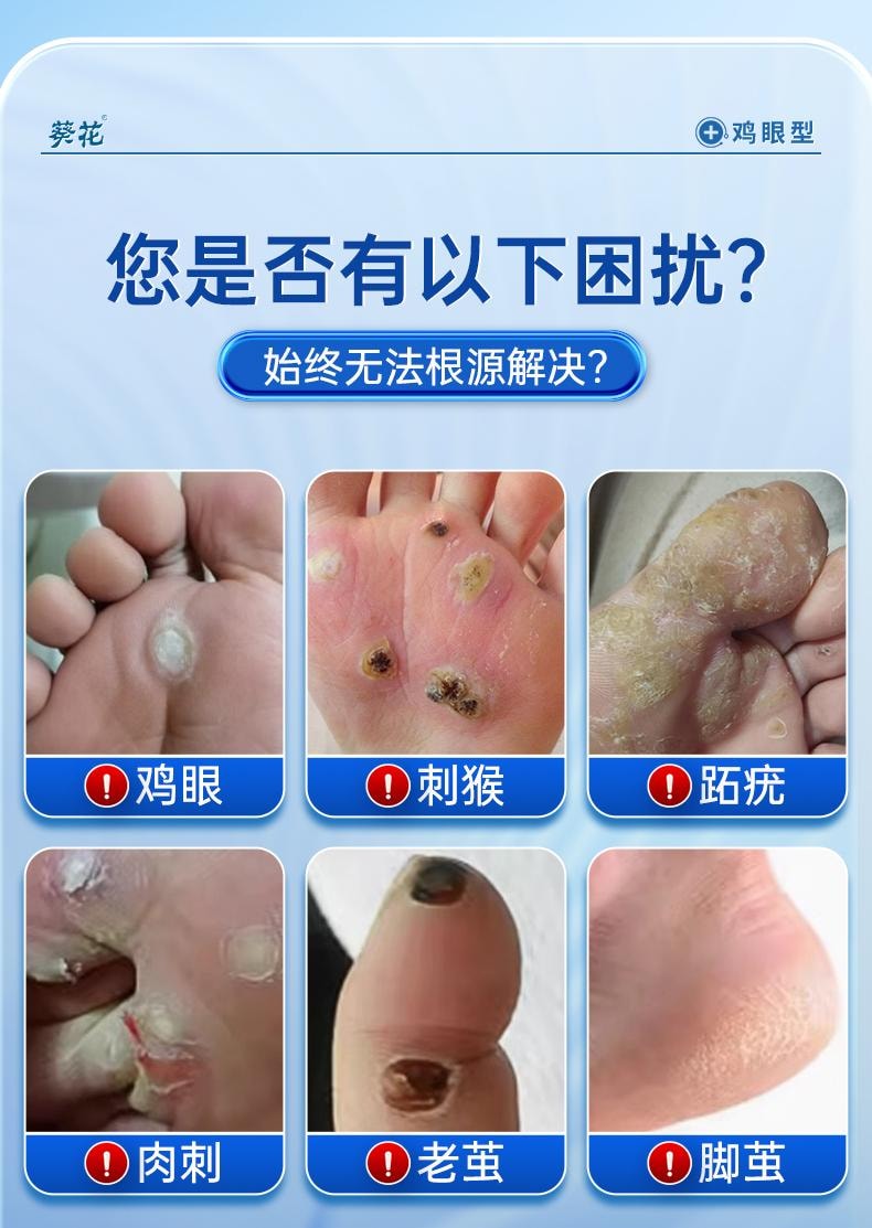 【中国直邮】 葵花药业 鸡眼型 医用退热凝胶 去脚上手上鸡眼脚底老茧肉刺瘊子脚钉鸡眼膏 20g/盒