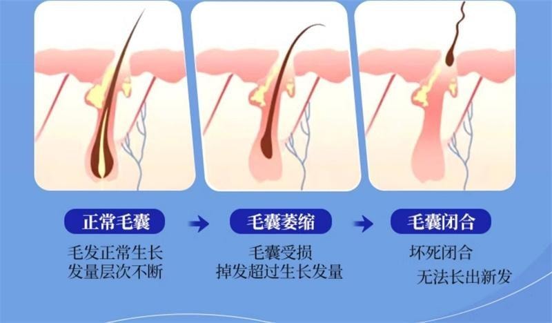 【中國直郵】 EHD 防脫護髮精華液強韌健發滋養柔順髮際線男女蓬鬆 60ml瓶