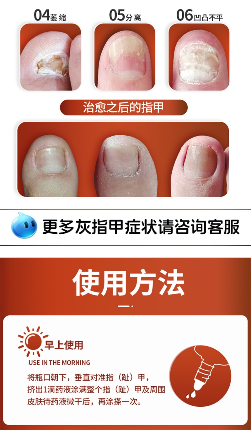 【中國直郵】亮甲 複方聚維酮碘搽劑灰指甲專用藥去甲癬治療指甲藥殺滅真菌 3mL x 1盒
