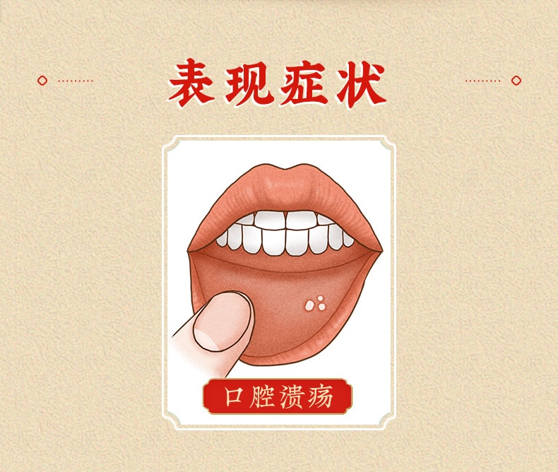【中國直郵】北京同仁堂 口腔潰瘍散粉 清熱斂瘡 用於口腔潰瘍3g*6瓶