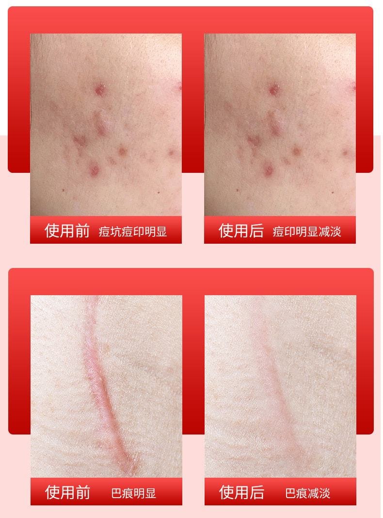 中國 健醫師 醫用退燒凝膠 疤痕膏 燙傷燒傷術後增生創傷痘印巴痕凝膠型20g/支/盒