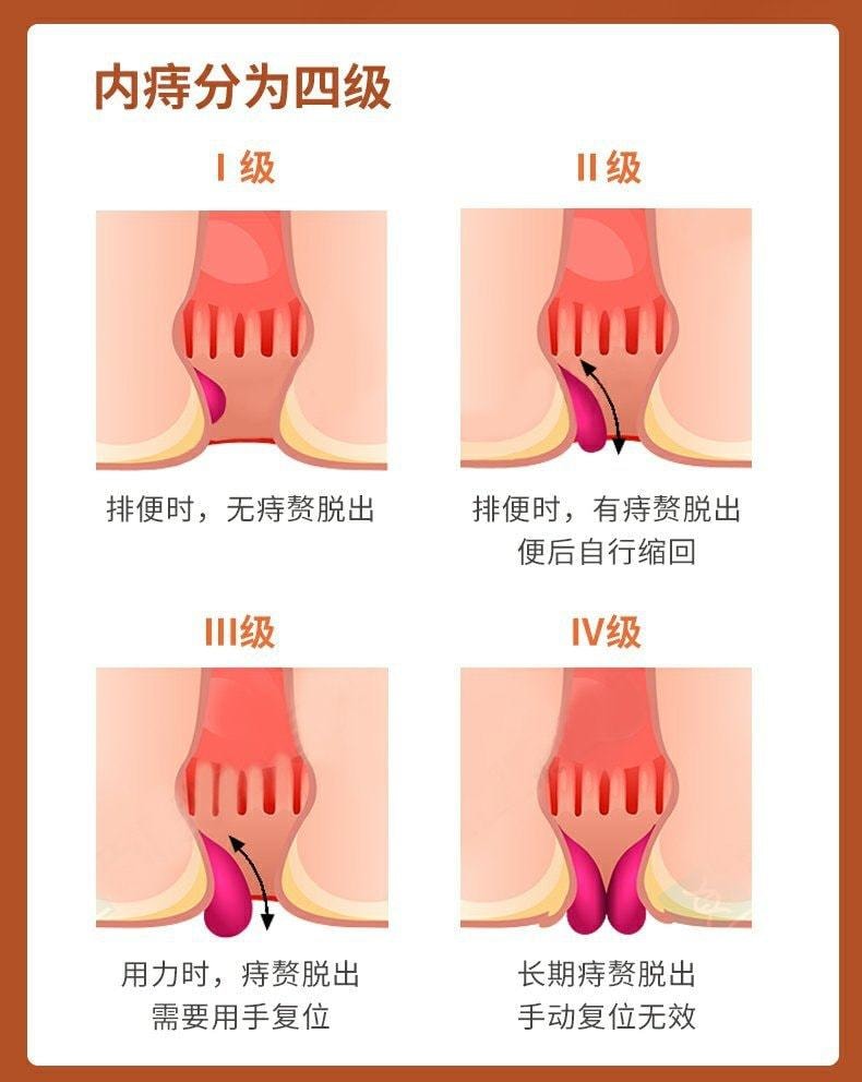 【中国直邮】马应龙 麝香痔疮栓 痔疮消肿止痛止血 神器消肉球痔疮药 18粒/盒