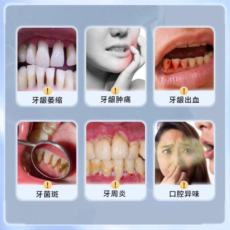 【中國直郵】 康齒寧 丁硼乳膏 刷掉牙菌斑 改善牙齦健康 用於口腔牙齦出血牙周炎去除口臭 70g/盒