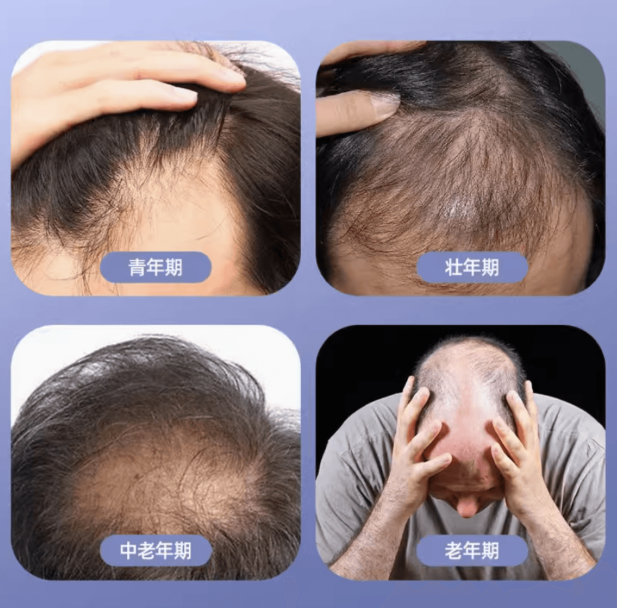 【日本直邮】大正制药男性生发液X5 PlusNeo加强型防脱发生发育毛剂 限男性用60ml