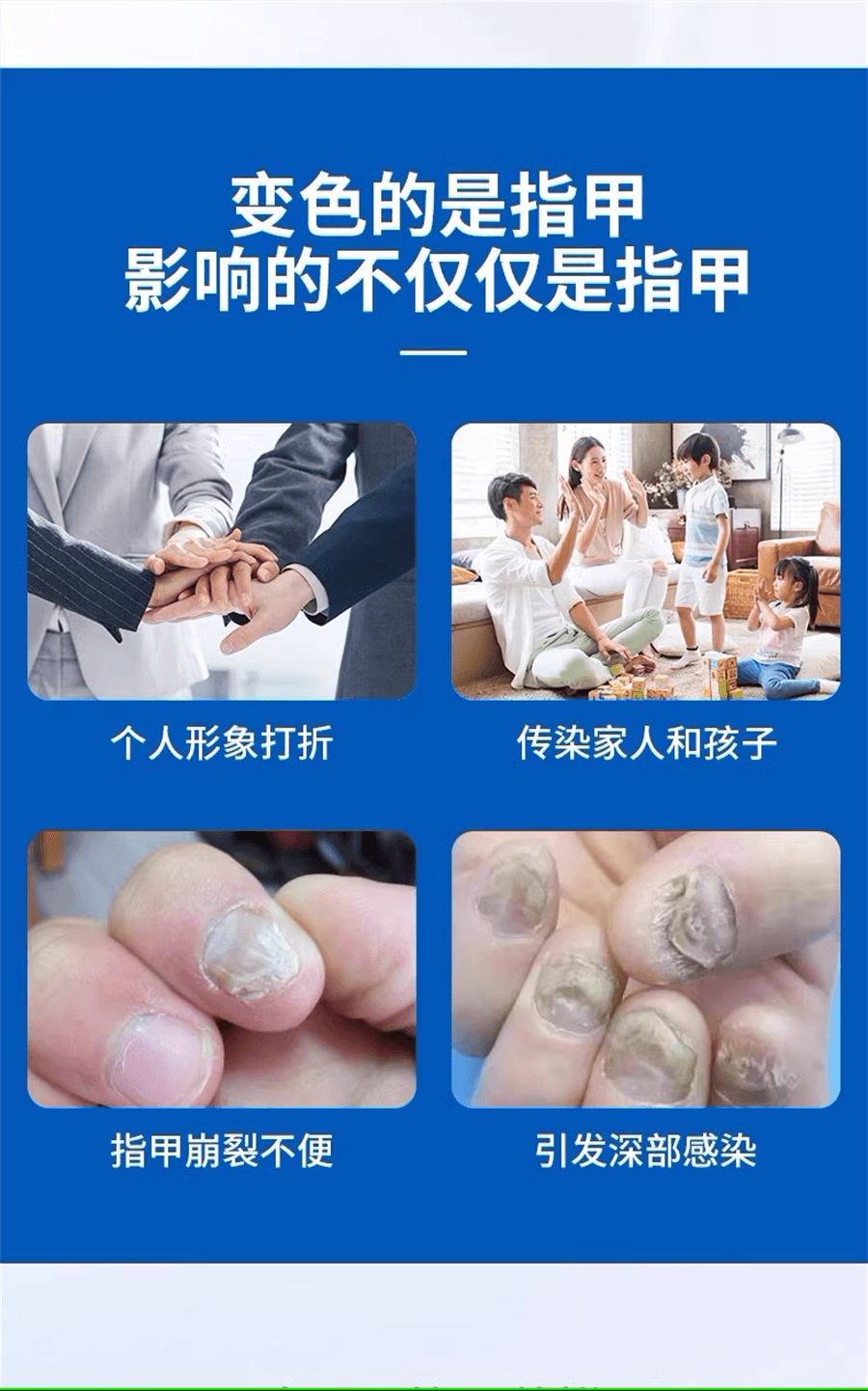 【中国直邮】丽点  盐酸阿莫罗芬搽剂灰指甲专用药治疗真菌药擦剂  2mL x 1盒