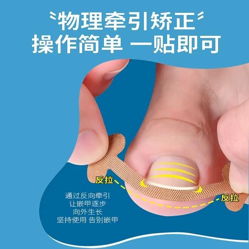 爱神严选 甲沟矫正器一套【嵌甲贴20贴+垫片20根】 专治甲沟炎嵌甲贴片 脚趾甲往肉里长专用隔离填充垫 正甲工具神器