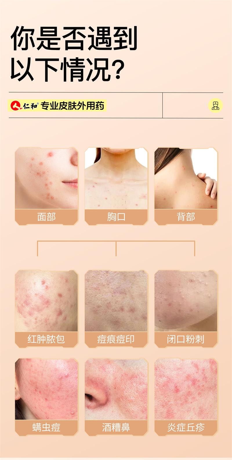 【中国直邮】 仁和 新肤螨灵软膏杀除螨虫祛痘痘印痤疮药膏修复淡化去痘止痒正品  15g
