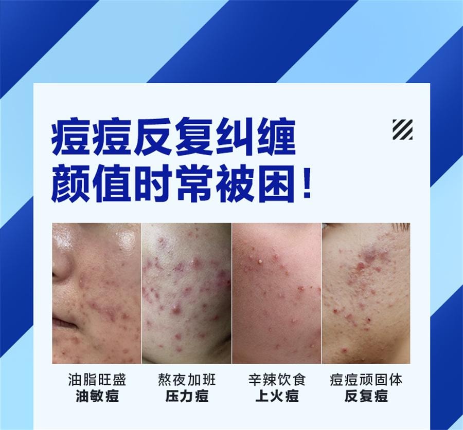 【中国直邮】 海洋至尊 清肌祛痘膏 去痘印修复淡化痘印痘坑痘疤男士面霜20g/支