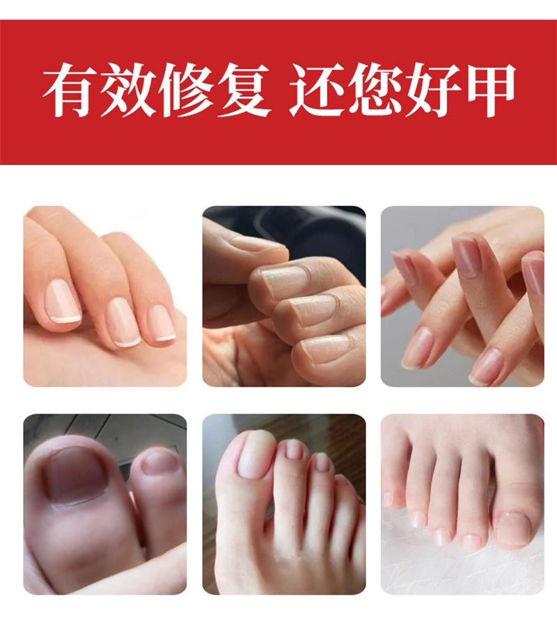 美國 南京同仁堂 灰指甲專用液體 甲溝炎藥水修腳剪刀冰醋酸抑菌液 30ml+小搓板+棉花棒+護理貼+增效膏