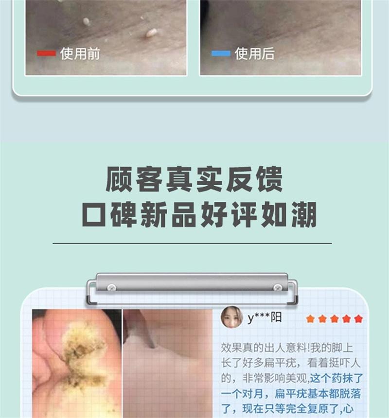  祥医堂 脖子肉粒丝状扁平疣去疣不留根 嘧腚抑菌克疣膏20g