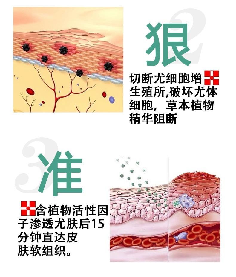  祥醫堂 絲狀扁平疣克尤刺瘊脖長小肉粒外用藥膏 5%咪喹莫特乳膏20g