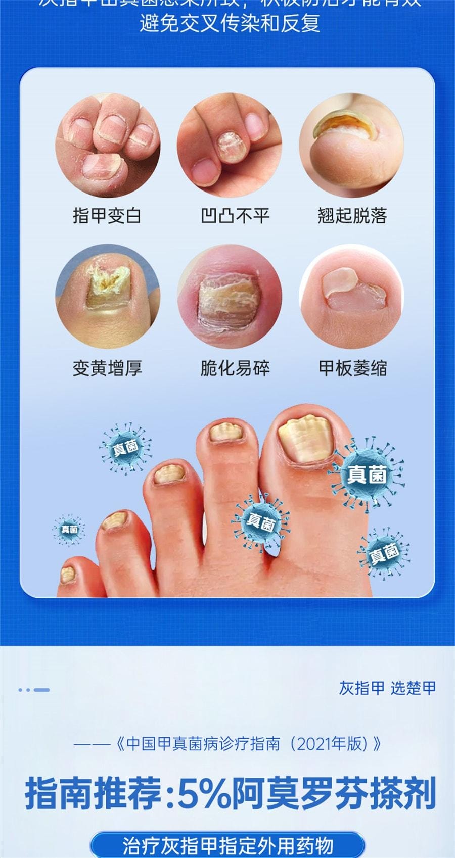 【中国直邮】 楚甲 盐酸阿莫罗芬搽剂 高效抗真菌 强力渗透 直击甲床 灰指甲专用特效药 2ml/盒