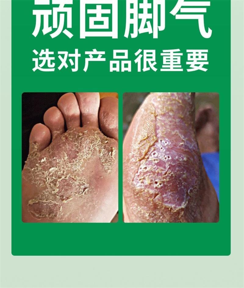 【中国直邮】 祥医堂 联苯苄唑喷雾 脚气喷雾 脚臭脚痒抑菌止痒抑菌液 60ml/盒(脚气克星)