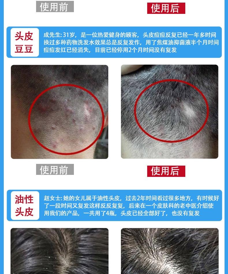  祥医堂 煤焦油抑菌洗液 抗皮脂溢出 改善止痒头皮控油去屑神器洗发水 60ml/盒