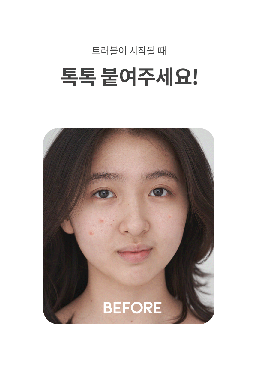 韩国 OOTD 星形羟基胶质痘痘贴 含烟酰胺和角麟成分 80片