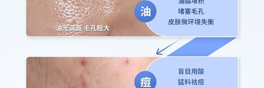 VOOLGA敷尔佳 清痘净肤次抛精华 2.0 1.5ml*30支 速效祛痘淡印 控油舒缓 油痘敏感肌适用