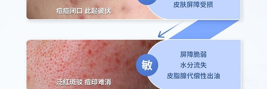 VOOLGA敷尔佳 清痘净肤次抛精华 2.0 1.5ml*30支 速效祛痘淡印 控油舒缓 油痘敏感肌适用