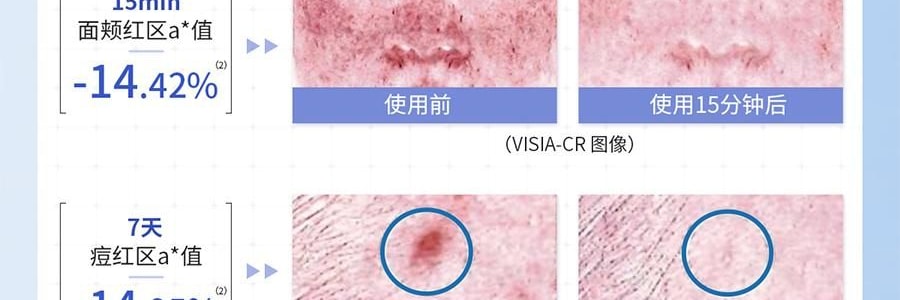 VOOLGA敷尔佳 清痘净肤次抛精华 2.0 1.5ml*30支 速效祛痘淡印 控油舒缓 油痘敏感肌适用