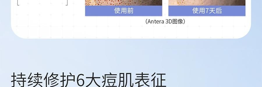 VOOLGA敷尔佳 清痘净肤次抛精华 2.0 1.5ml*30支 速效祛痘淡印 控油舒缓 油痘敏感肌适用