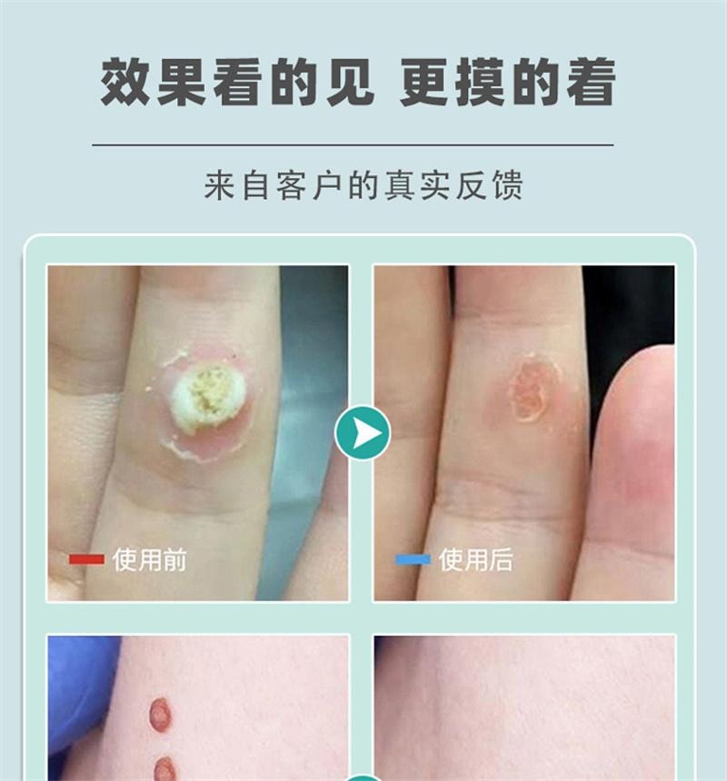  祥医堂 脖子肉粒丝状扁平疣去疣不留根 嘧腚抑菌克疣膏20g