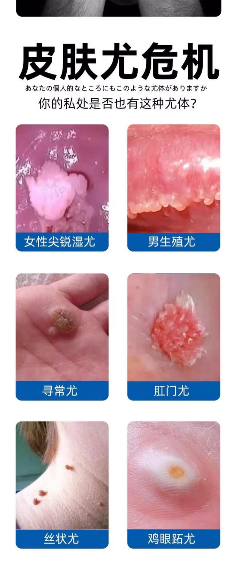 祥医堂 鬼臼毒素酊10ml/盒 去鸡眼尖锐丝状扁平克疣抑菌外用