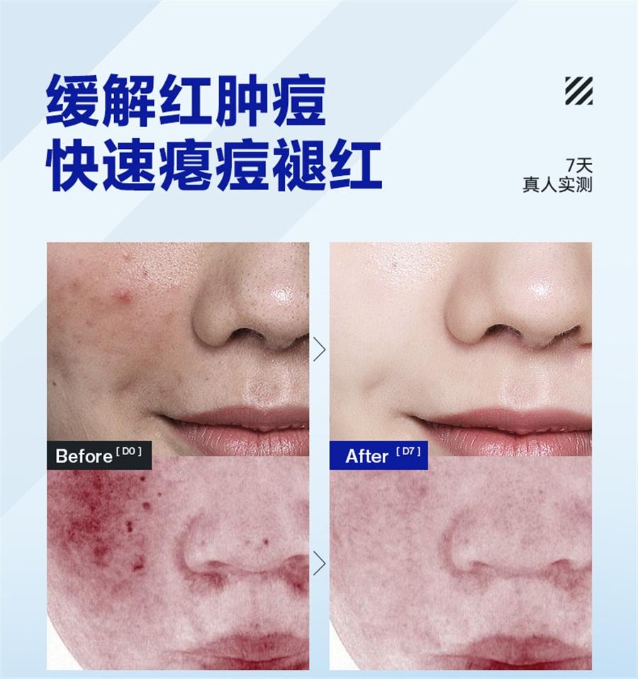 【中国直邮】 海洋至尊 清肌祛痘膏 去痘印修复淡化痘印痘坑痘疤男士面霜20g/支