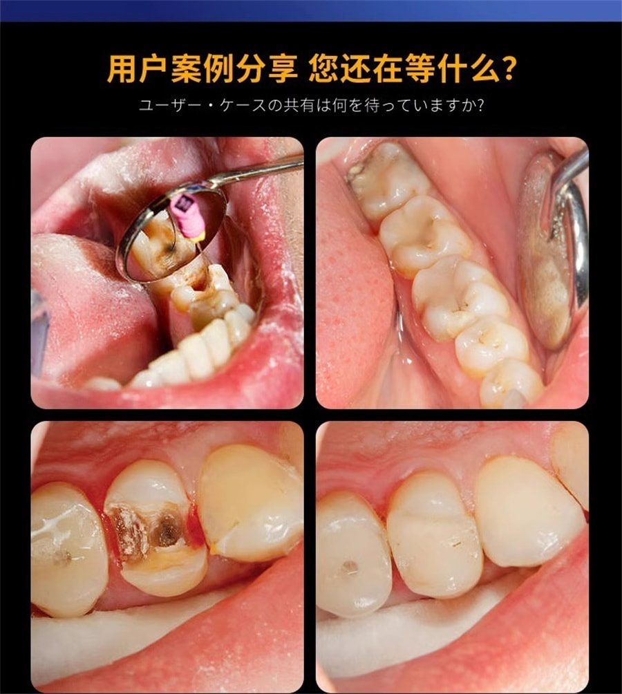 【中国直邮】正大 再生硅牙膏1支 牙周炎专用牙龈萎缩修复再生蛀牙牙洞清理龋齿非药