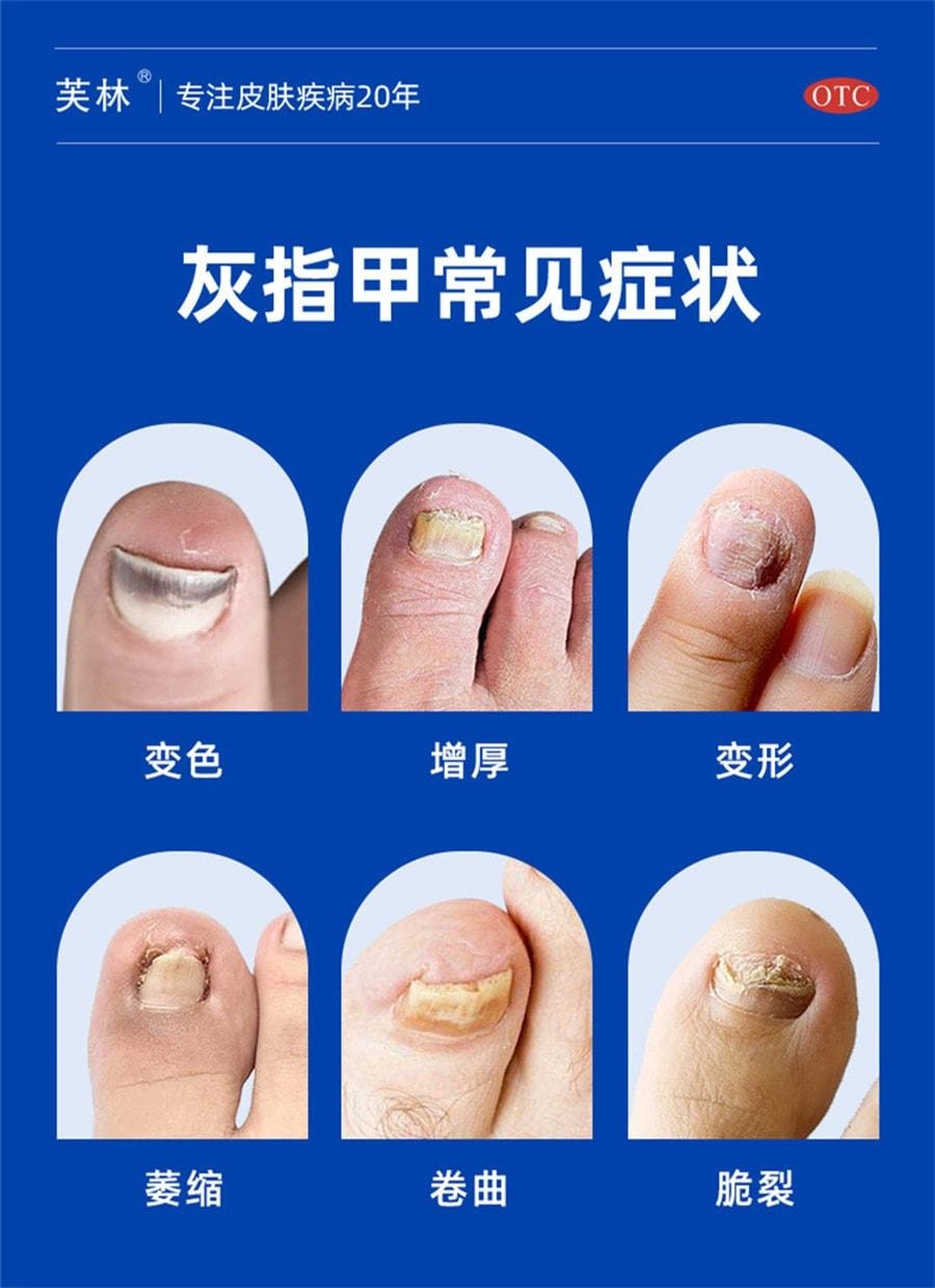 【中國直郵】 芙林 鹽酸阿莫羅芬搽劑 阿莫羅芬擦劑治灰指甲 強滲透 殺菌抑菌 1ml/盒