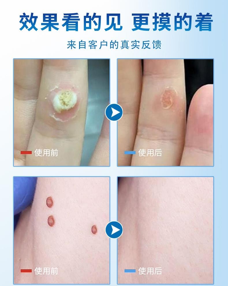 【中國直效郵件】 祥醫堂 鬼臼毒素酊 男女私處尖銳濕尤外用抑菌液 輕鬆應付各種尤痕包疹問題 10ml/盒